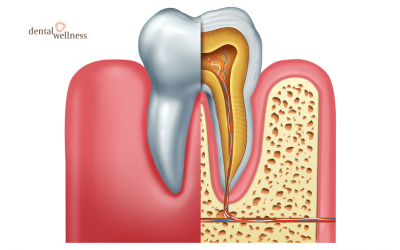 Is There Any Alternative to Root Canal Treatments? Part 1