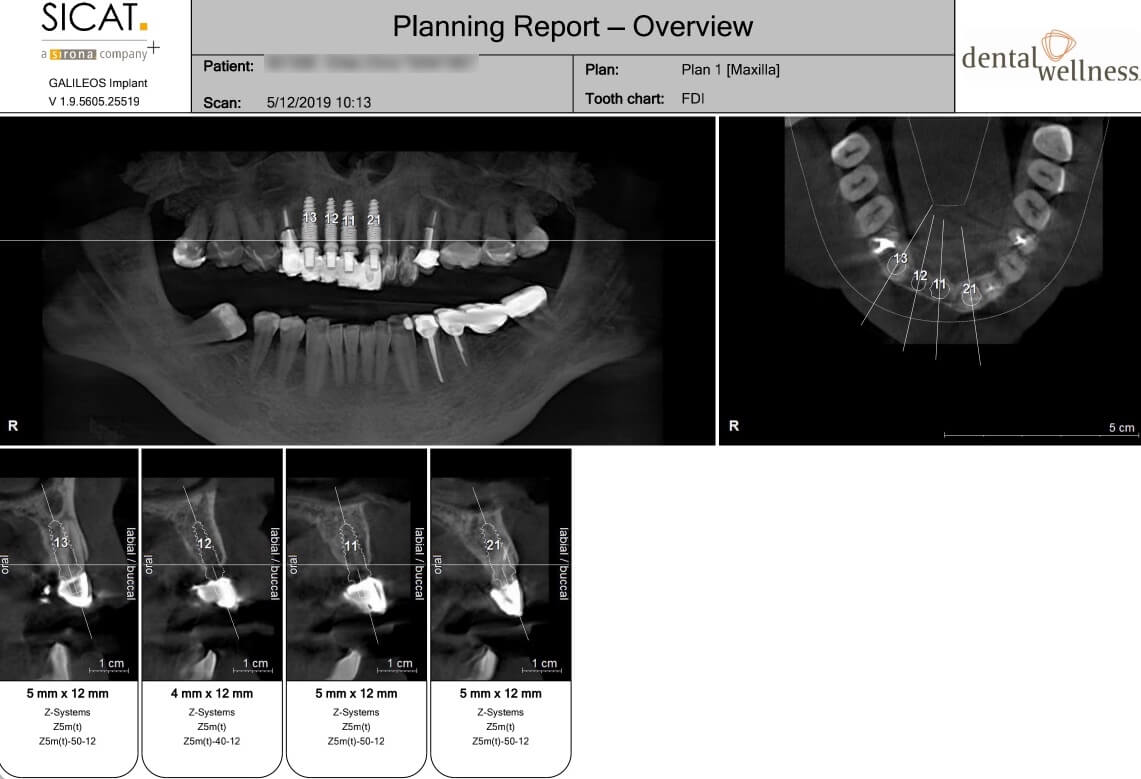 Ceramic Crown Case Study DW