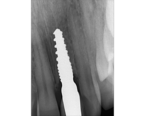 DW Casestudy Missing Tooth