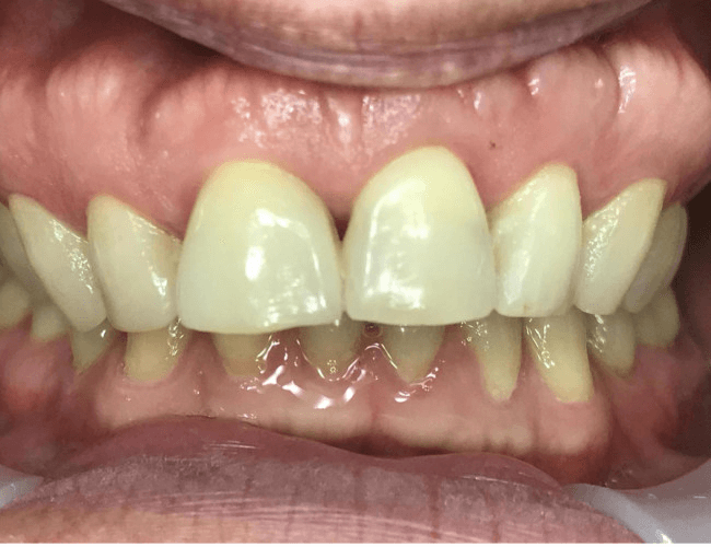 Same Day Zirconia Implant