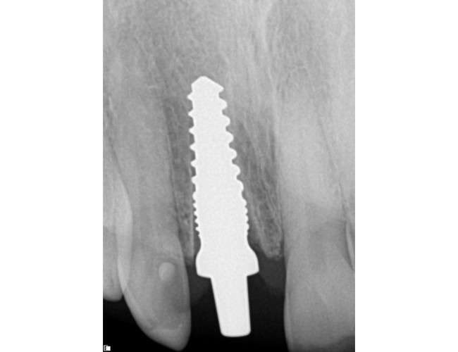 Same Day Zirconia Implants