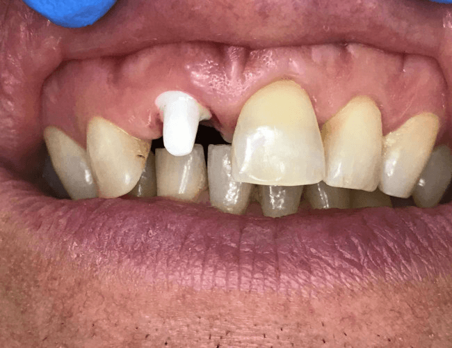 Same Day Zirconia Implants