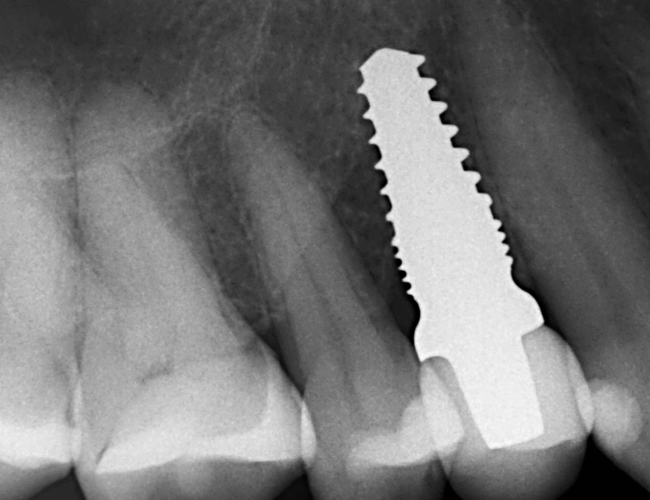 Same Day Crown Implant Set