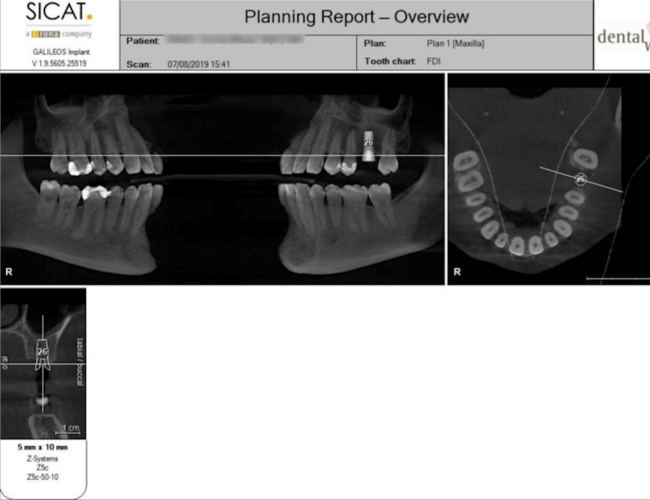 Replacing Back Tooth