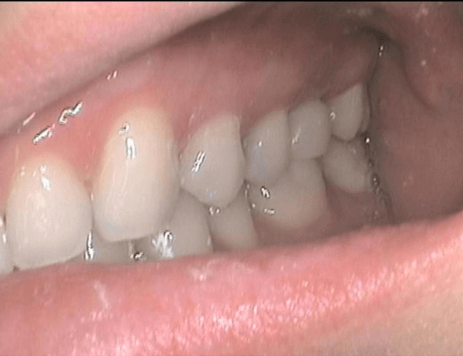 Replacing Failed Root Canal