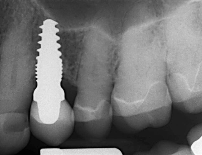 Replacing Back Tooth