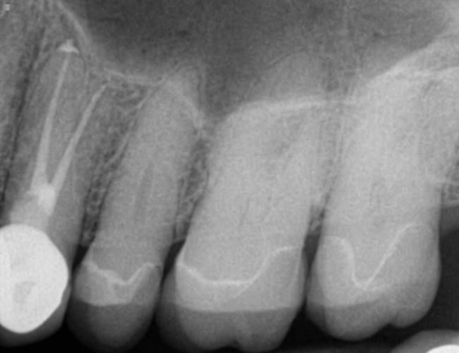 Replacing Back Tooth