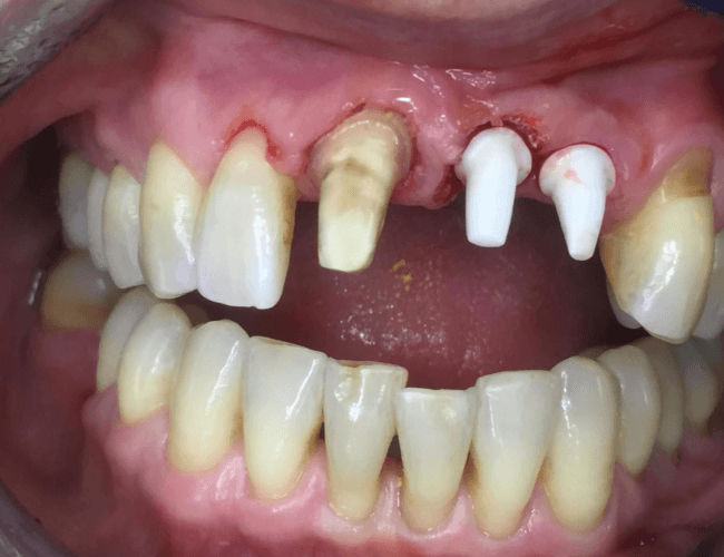 Front Tooth Replacement