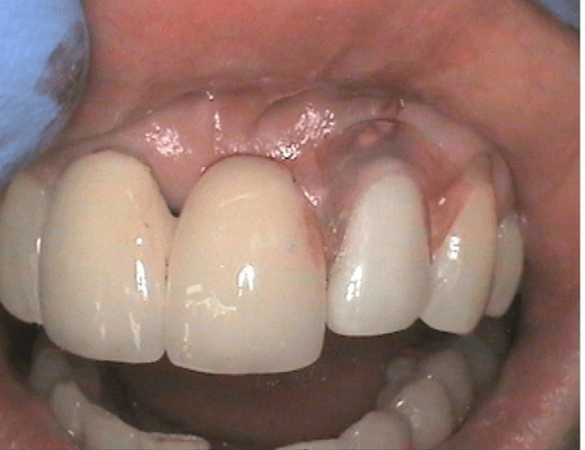 Front Tooth Replacement