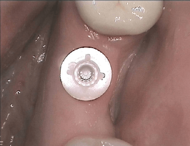 Replacing Root Canal Molar with Zirconia