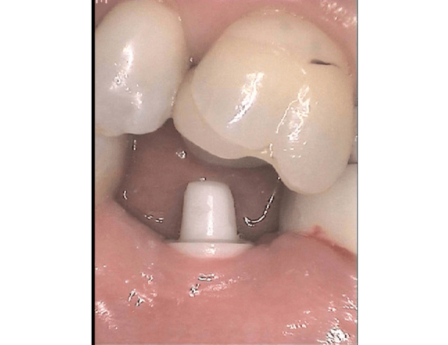 Replacing Root Canal Molar with Zirconia