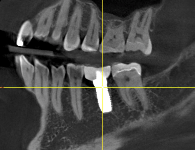 Replacing Root Canal Molar with Zirconia