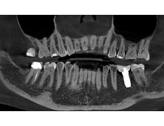 Replacing Root Canal Molar with Zirconia