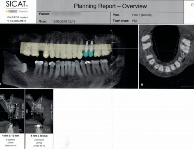 Replace Side Chewing Teeth