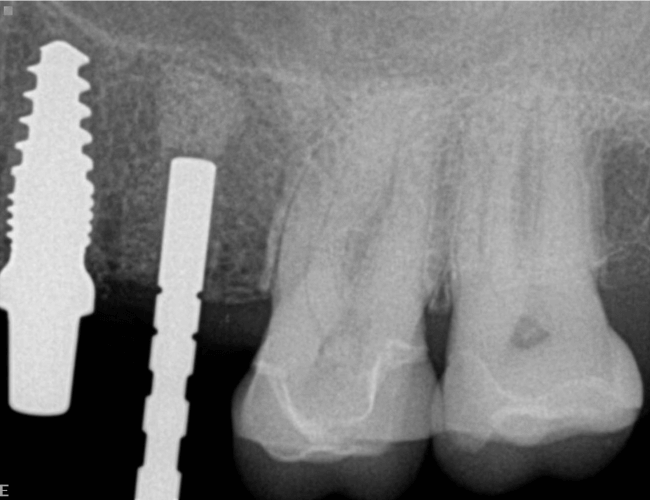 Replace Side Chewing Teeth