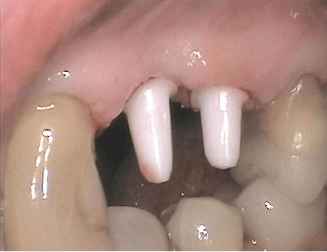 Replace Side Chewing Teeth