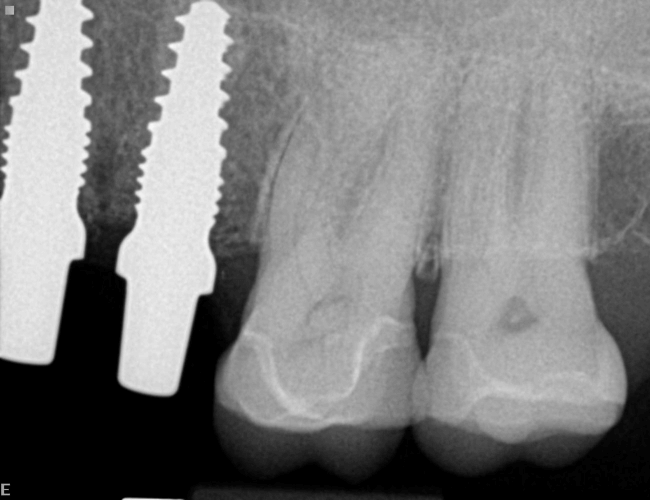 Replace Side Chewing Teeth