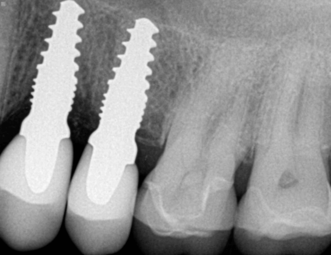 Replace Side Chewing Teeth