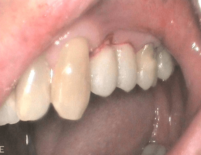 Replace Side Chewing Teeth