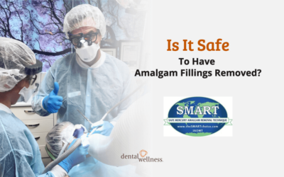 Is It Safe to Have Amalgam Fillings Removed?