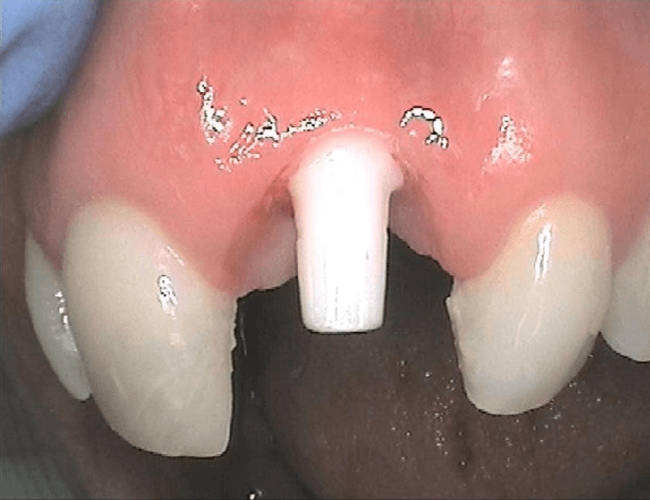 Restoring Beautiful Smiles