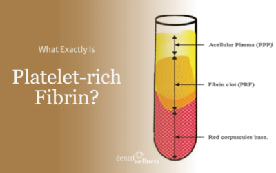 What Exactly Is Platelet-rich Fibrin?