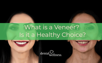 What is a Veneer? Is it a Healthy Choice?