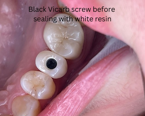 Black Vicarb screw before sealing with white resin