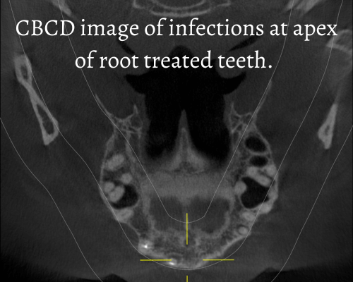 CBCT